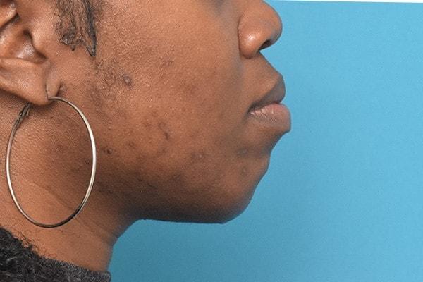 Chin Implant after at Kirk Lozada, MD, Facial Plastic Surgery in Philadelphia, PA