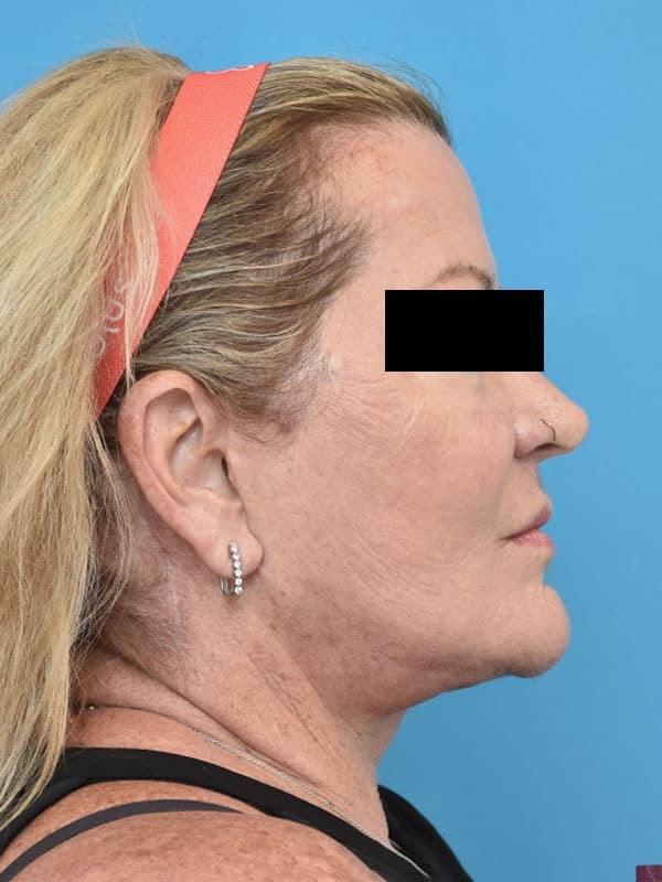 Facelift after at Kirk Lozada, MD, Facial Plastic Surgery in Philadelphia, PA