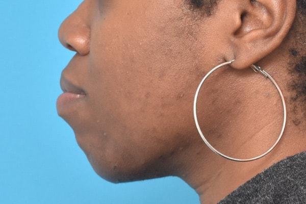 Chin Implant after at Kirk Lozada, MD, Facial Plastic Surgery in Philadelphia, PA