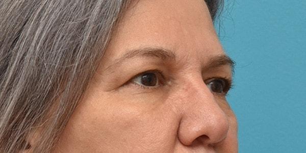 Brow Lift before at Kirk Lozada, MD, Facial Plastic Surgery in Philadelphia, PA