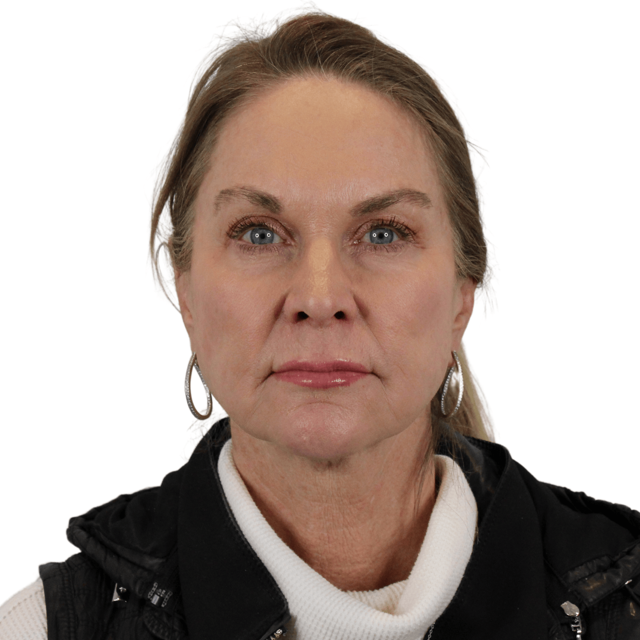 Mini Facelift before at AdmireMD Plastic Surgery + Skin Clinic in Scottsdale, AZ