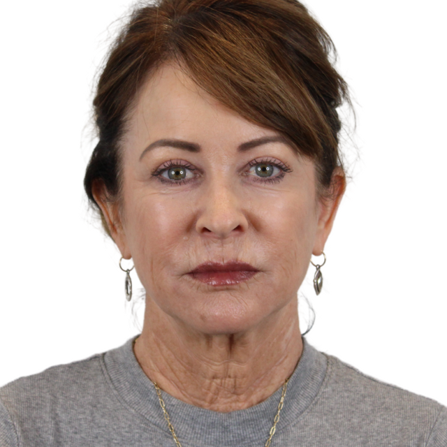 Mini Facelift before at AdmireMD Plastic Surgery + Skin Clinic in Scottsdale, AZ