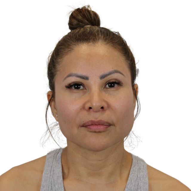 Functional Rhinoplasty after at AdmireMD Plastic Surgery + Skin Clinic in Scottsdale, AZ