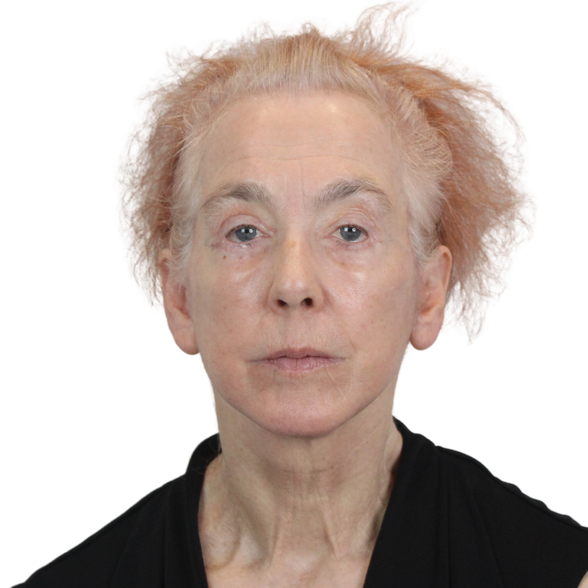 AdmireMD Plastic Surgery + Skin Clinic after — Scottsdale, AZ