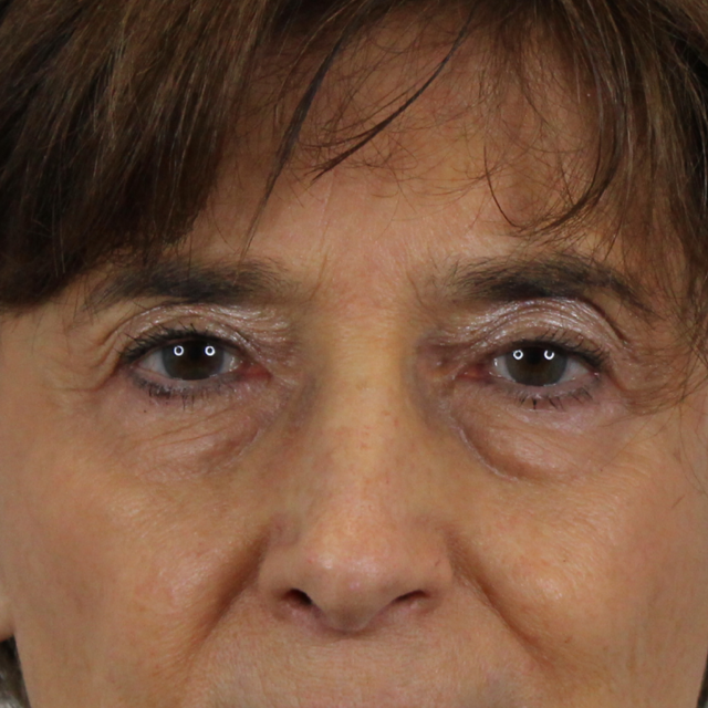 Blepharoplasty before at AdmireMD Plastic Surgery + Skin Clinic in Scottsdale, AZ