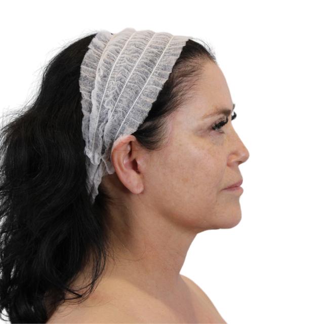 Neck Lift after at AdmireMD Plastic Surgery + Skin Clinic in Scottsdale, AZ