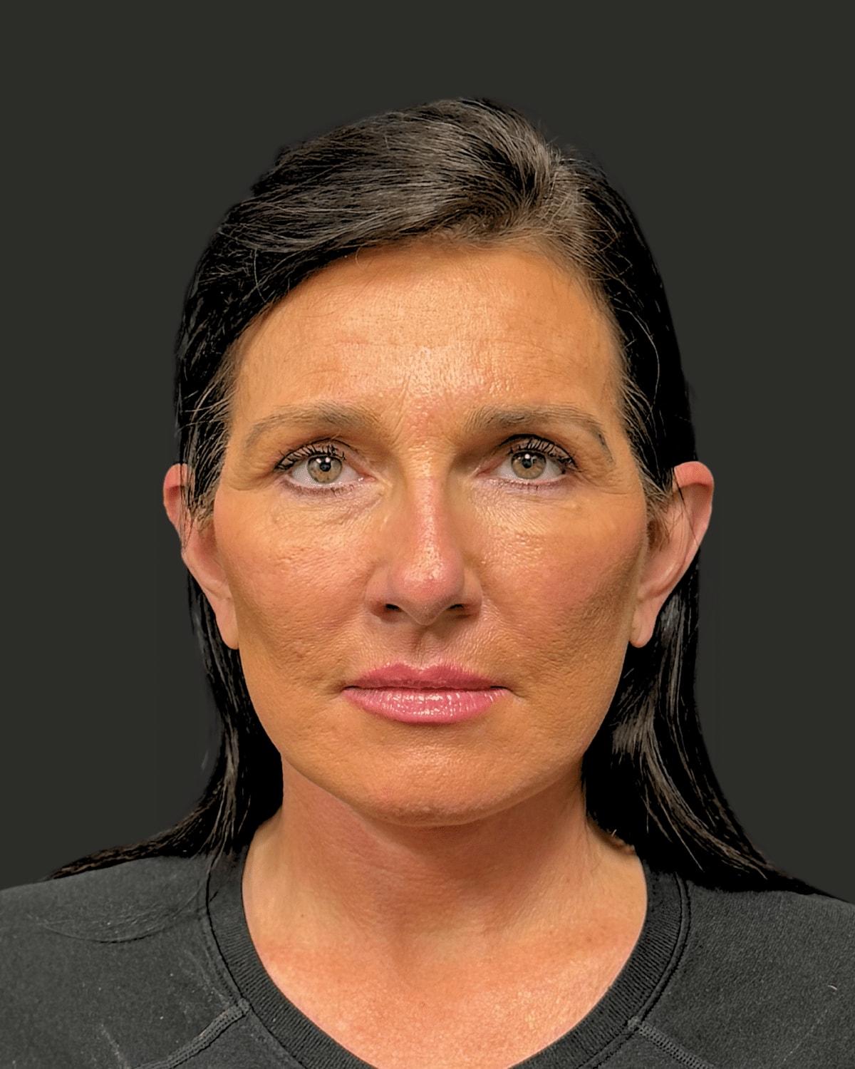William J. Rifkin, MD facelift after — New York, NY