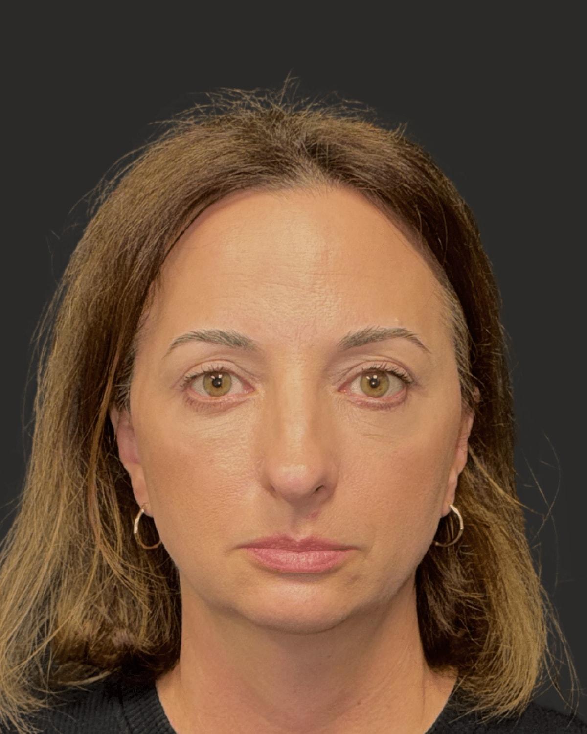 William J. Rifkin, MD eyelid lift after — New York, NY