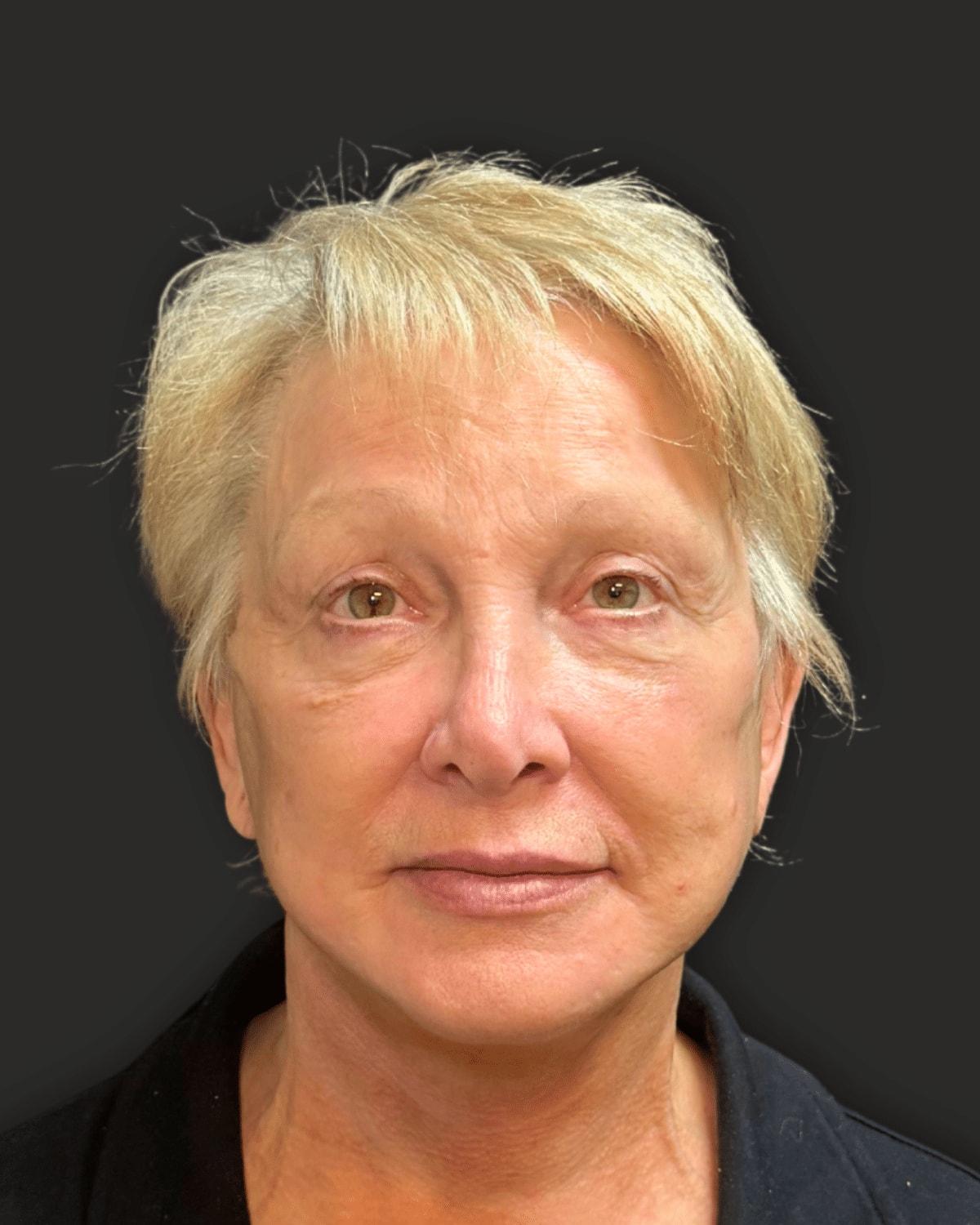 William J. Rifkin, MD eyelid lift after — New York, NY