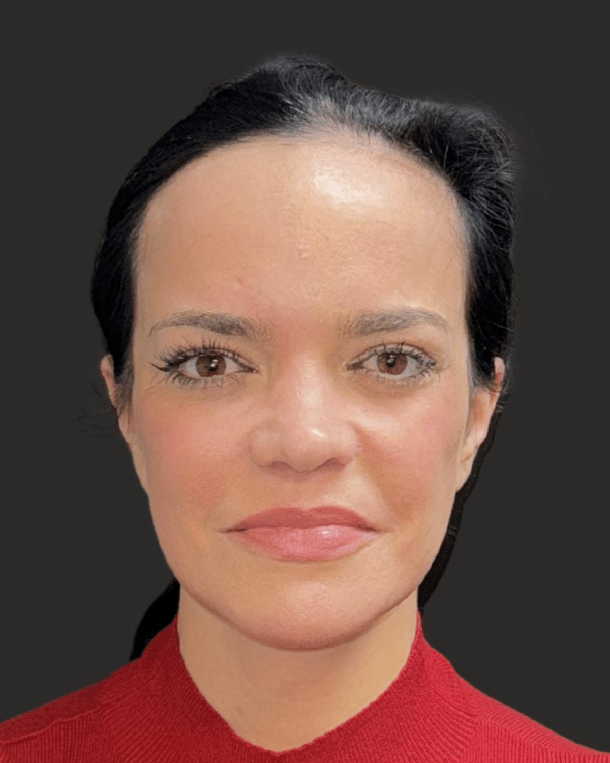 William J. Rifkin, MD facelift after — New York, NY