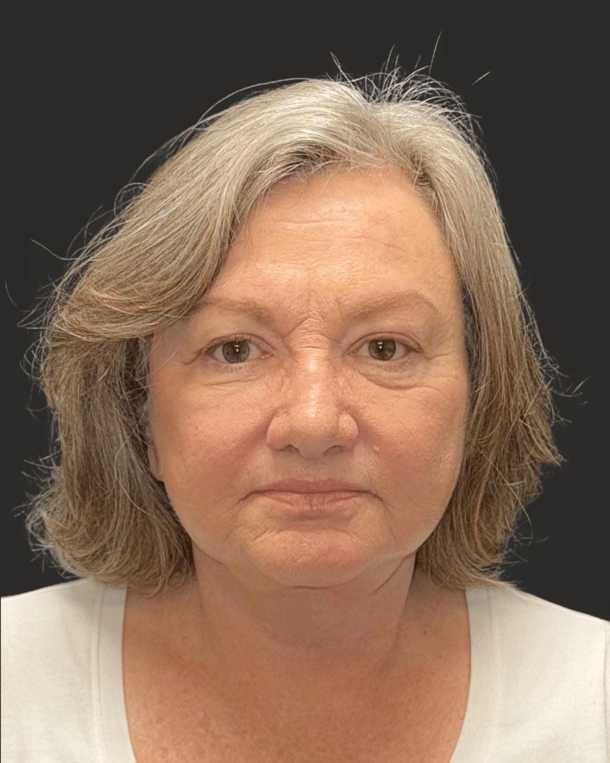 William J. Rifkin, MD facelift after — New York, NY