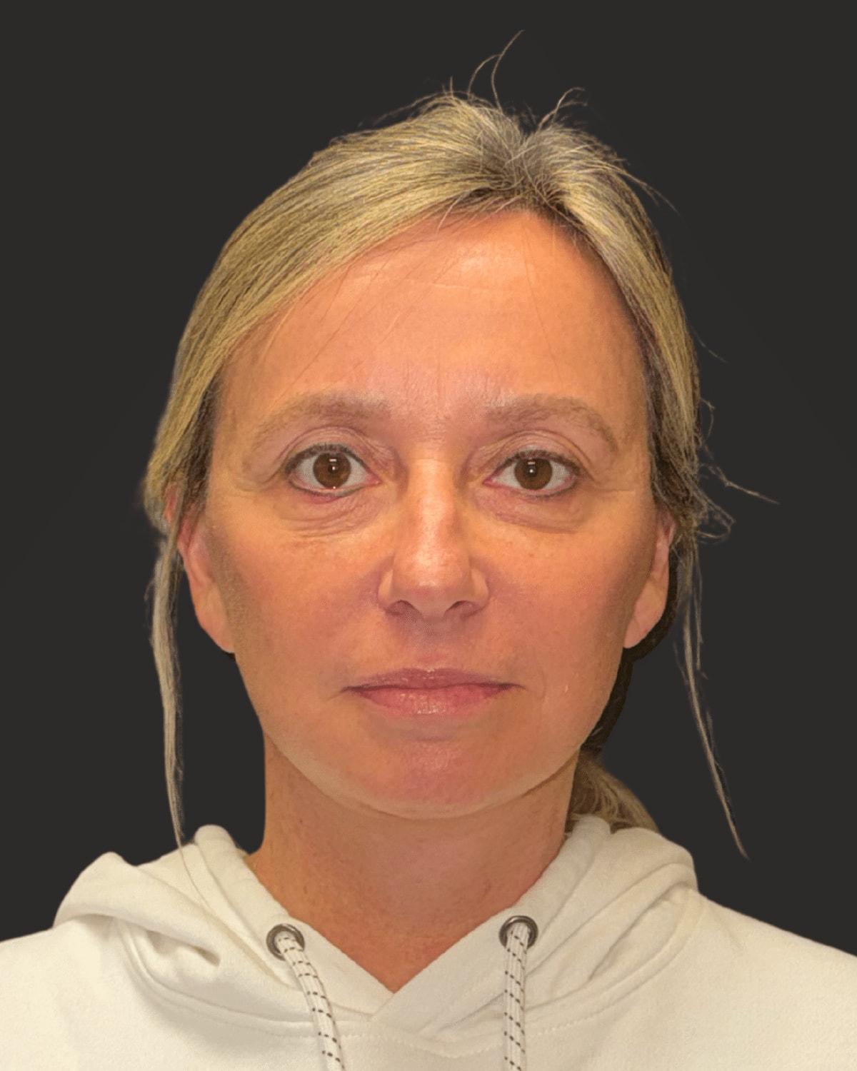 William J. Rifkin, MD facelift after — New York, NY