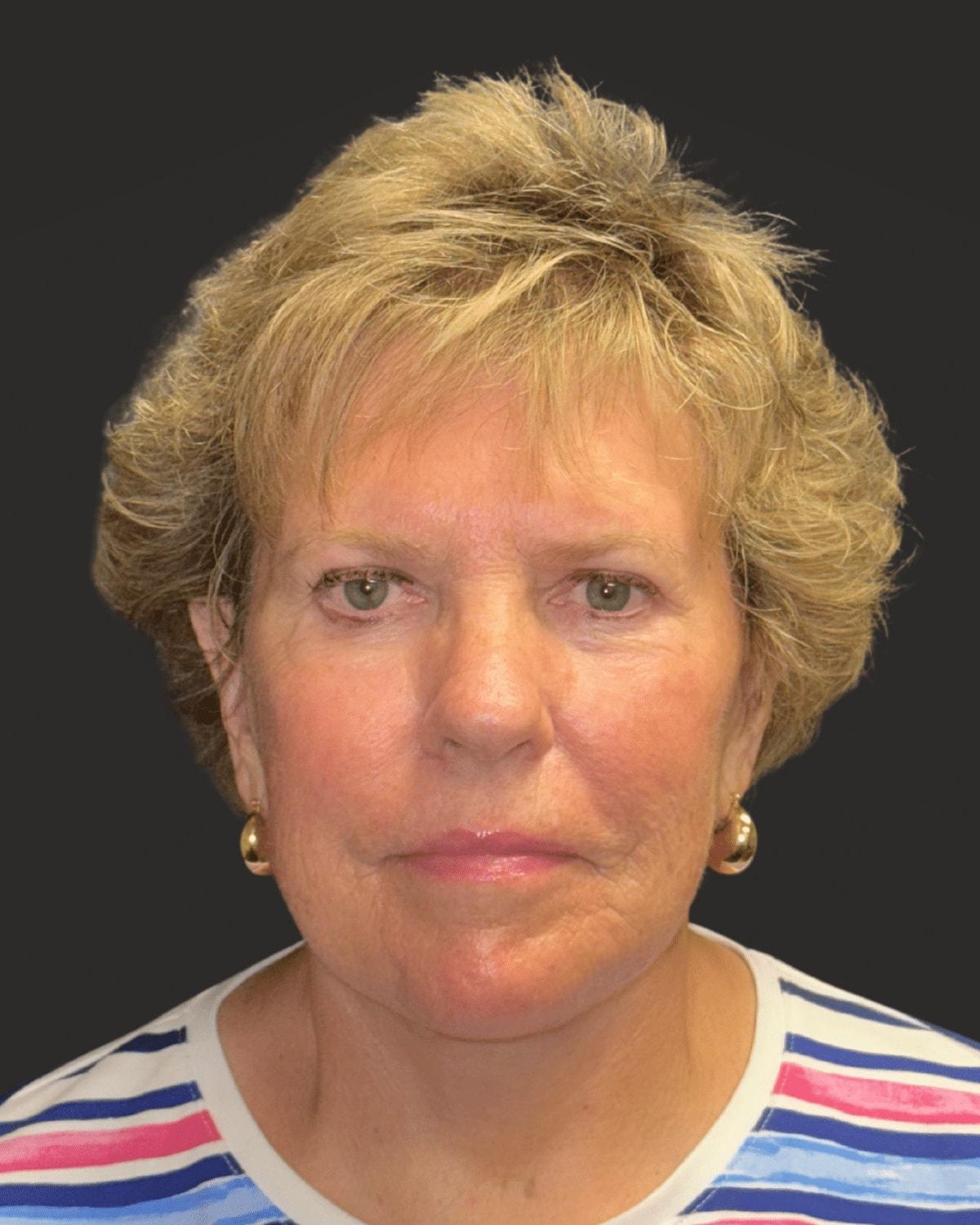 William J. Rifkin, MD facelift after — New York, NY