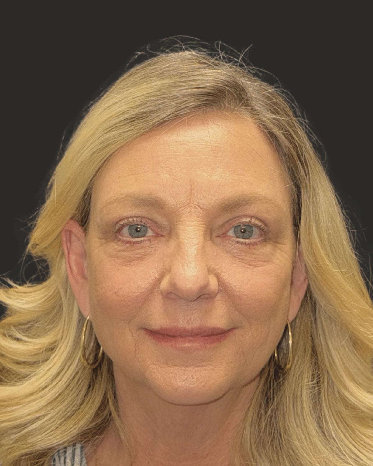 William J. Rifkin, MD eyelid lift after — New York, NY