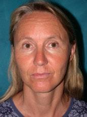 Carolyn C Chang, MD facelift after — San Francisco, CA