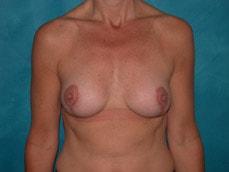 Carolyn C Chang, MD breast lift after — San Francisco, CA