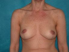 Carolyn C Chang, MD breast lift after — San Francisco, CA