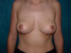 Carolyn C Chang, MD breast lift after — San Francisco, CA