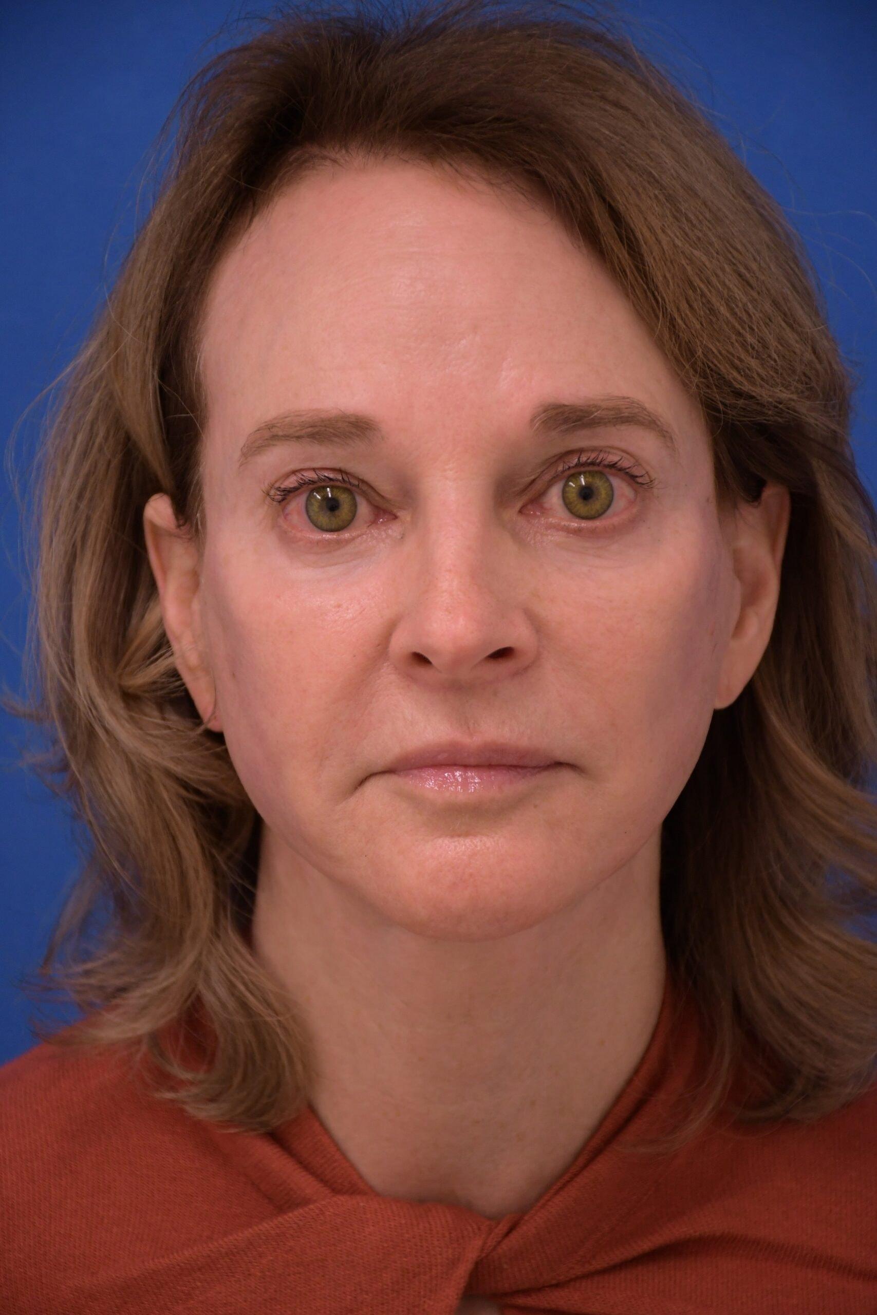 Carolyn C Chang, MD facelift after — San Francisco, CA