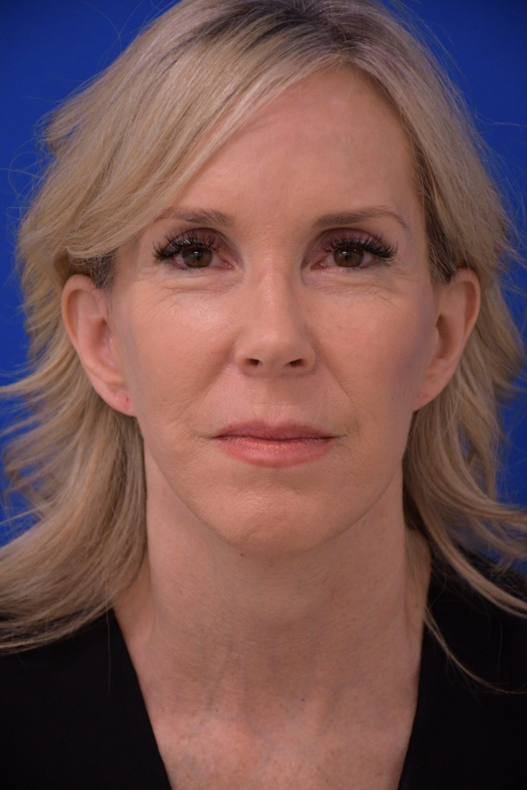 Carolyn C Chang, MD facelift after — San Francisco, CA