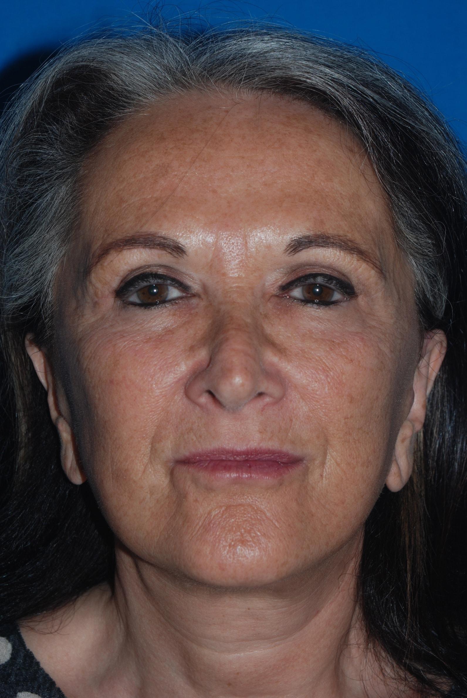 Carolyn C Chang, MD facelift after — San Francisco, CA