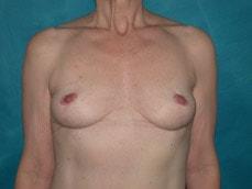 Carolyn C Chang, MD breast lift after — San Francisco, CA