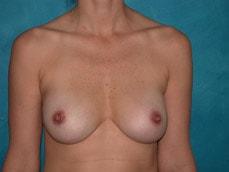 Carolyn C Chang, MD breast augmentation revision after — San Francisco, CA