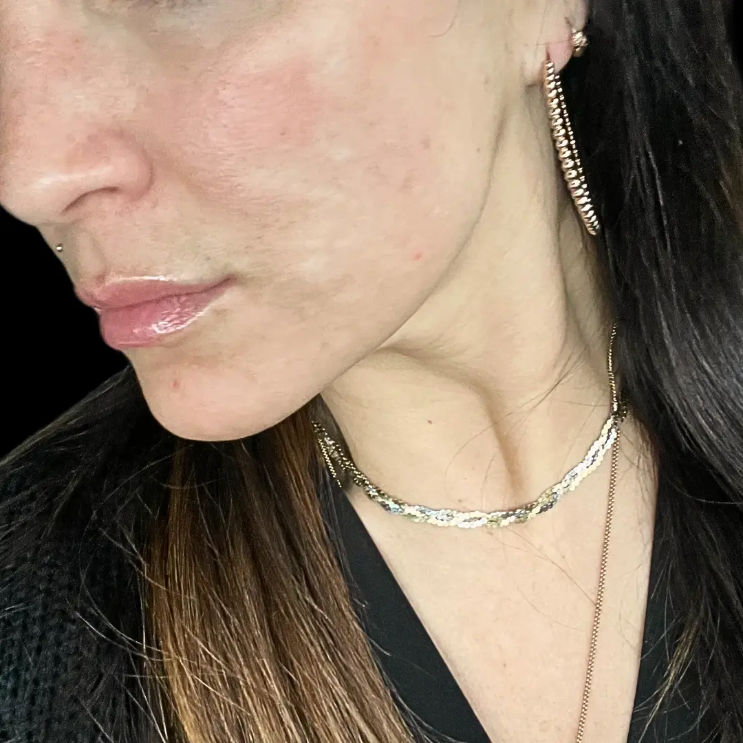 House of Aesthetics photofacial after — Cary, NC