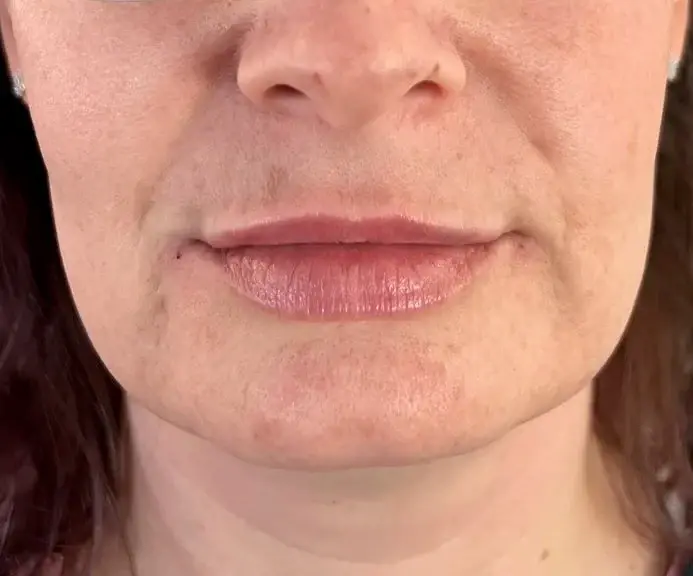 House of Aesthetics lip filler after — Cary, NC
