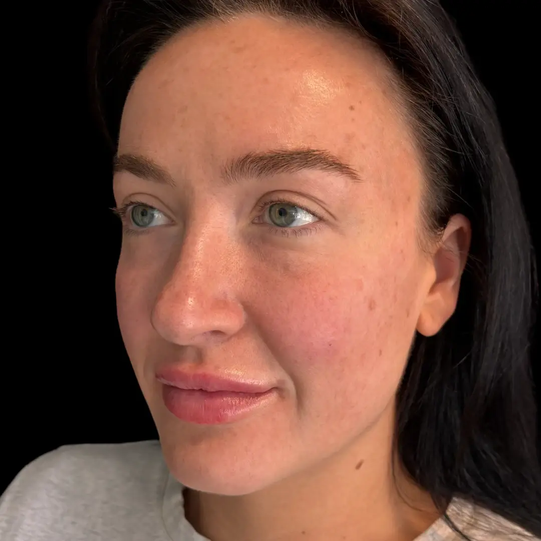 House of Aesthetics lip filler after — Cary, NC