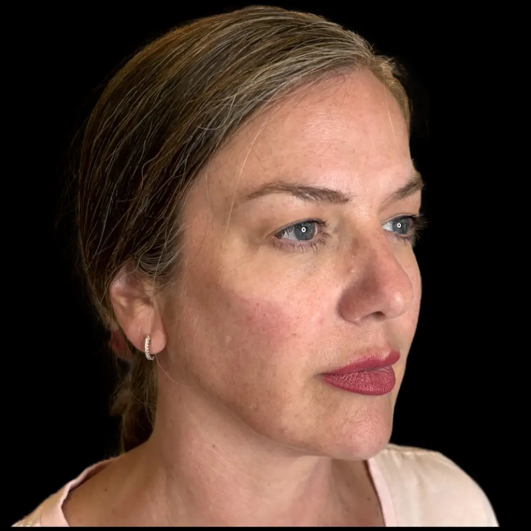 House of Aesthetics cheek filler after — Cary, NC