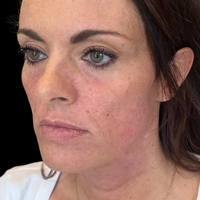 Dermal Fillers before at House of Aesthetics in Cary, NC