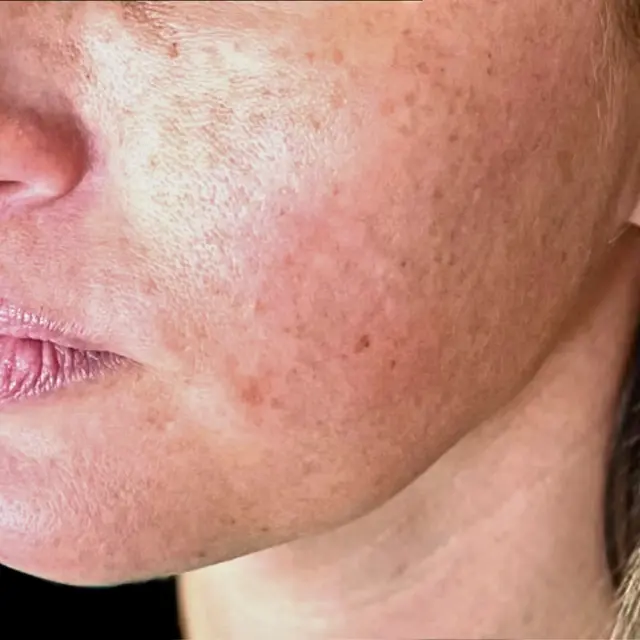 Laser Skin Resurfacing before at House of Aesthetics in Cary, NC