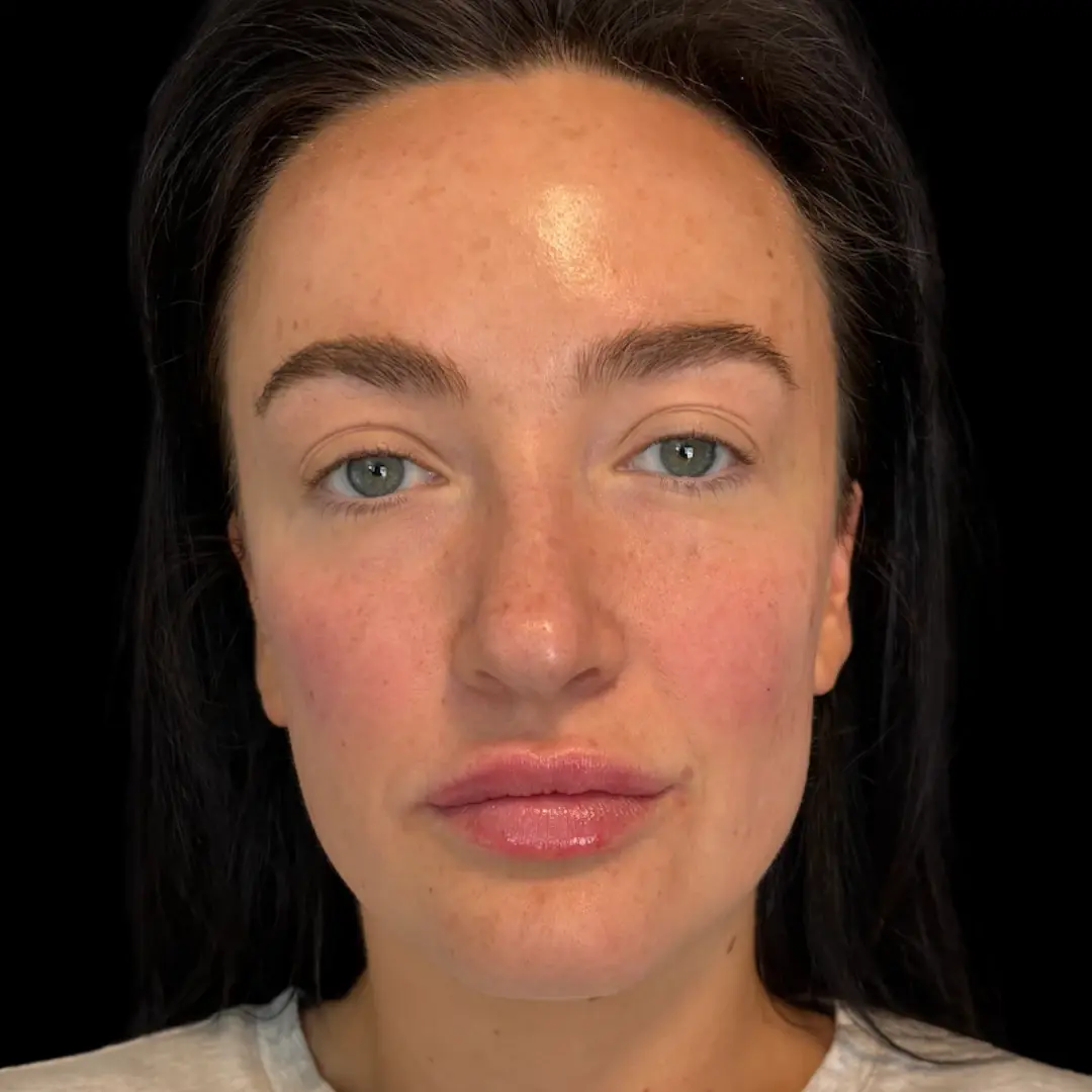 House of Aesthetics lip filler after — Cary, NC