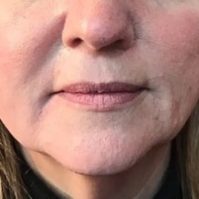 Lip Filler after at House of Aesthetics in Cary, NC