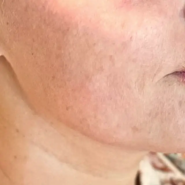 Laser Skin Resurfacing after at House of Aesthetics in Cary, NC