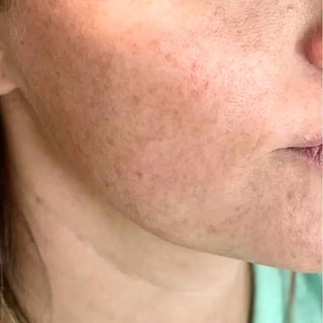 Laser Skin Resurfacing before at House of Aesthetics in Cary, NC