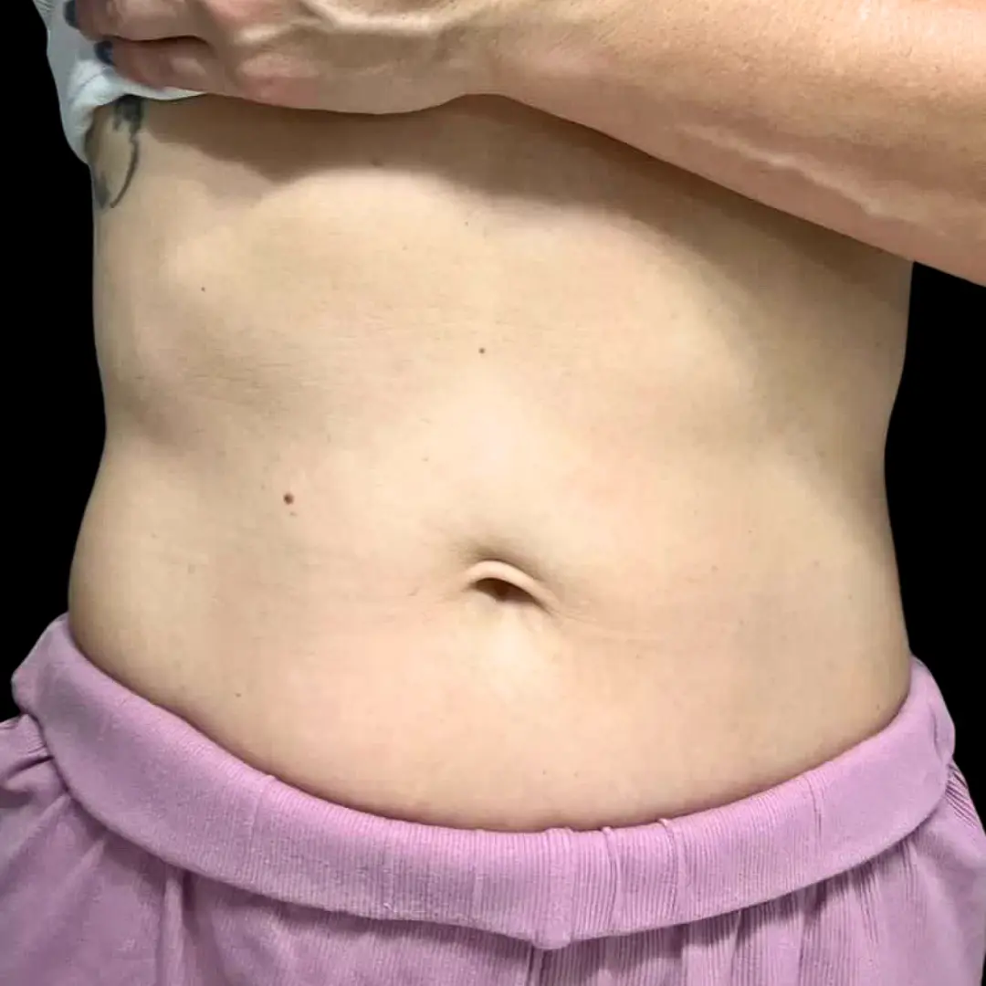 House of Aesthetics laser treatment after — Cary, NC