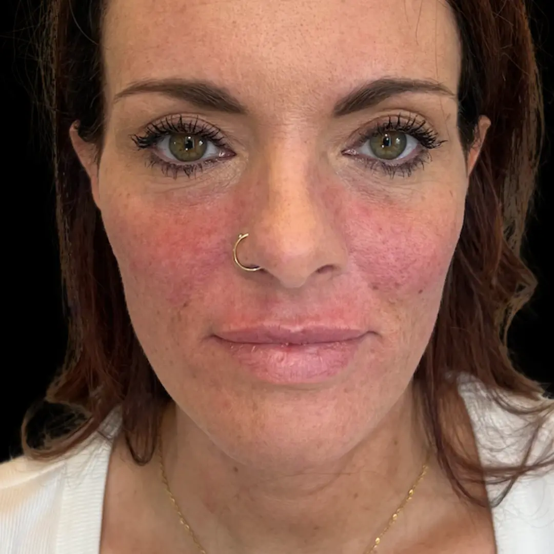 House of Aesthetics cheek filler after — Cary, NC