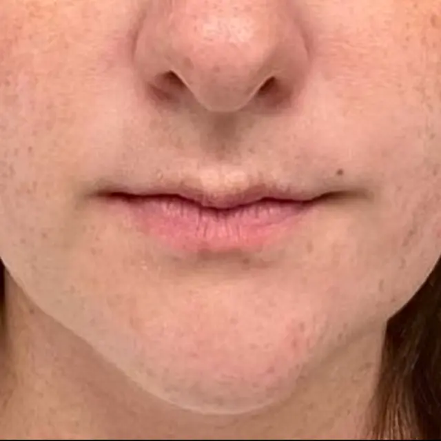 Lip Filler before at House of Aesthetics in Cary, NC