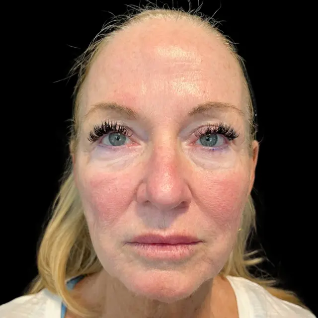 Dermal Fillers before at House of Aesthetics in Cary, NC