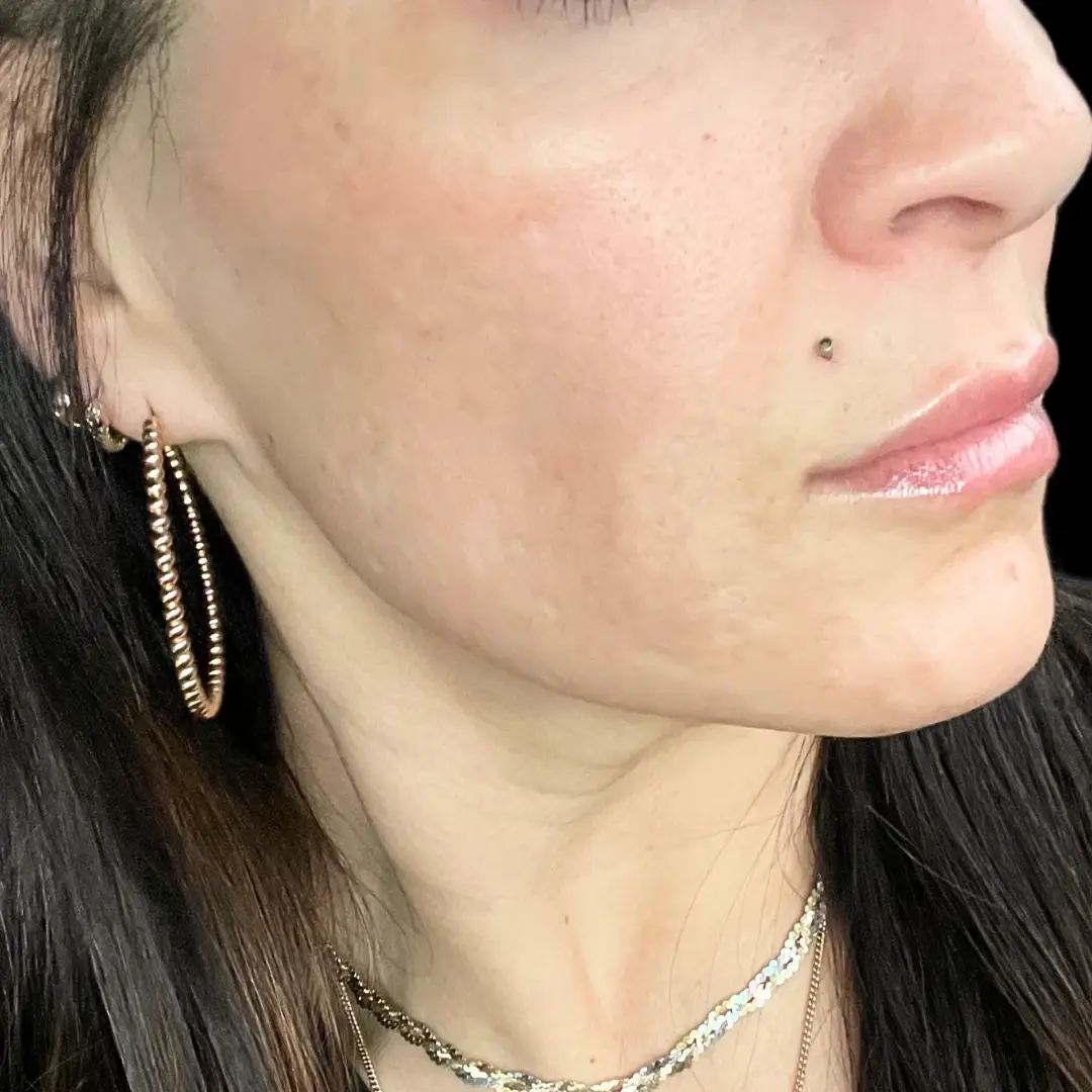 House of Aesthetics photofacial after — Cary, NC