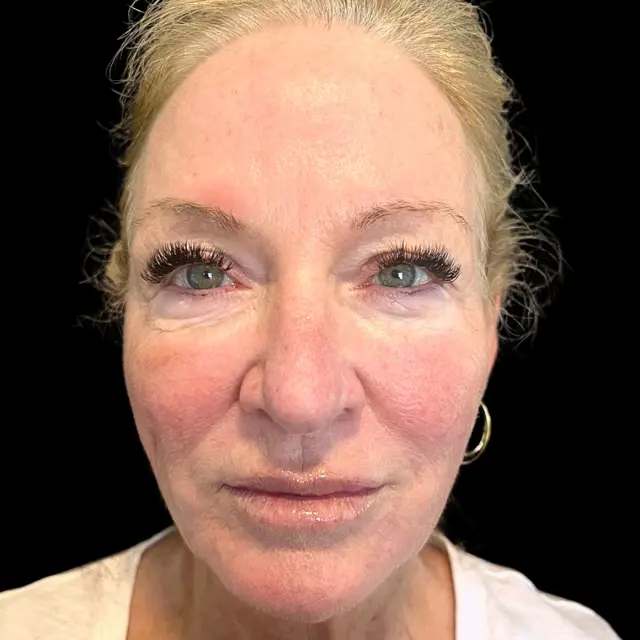 Dermal Fillers after at House of Aesthetics in Cary, NC