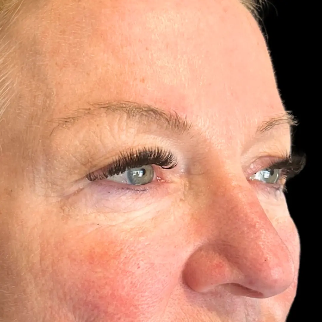 House of Aesthetics under-eye filler after — Cary, NC