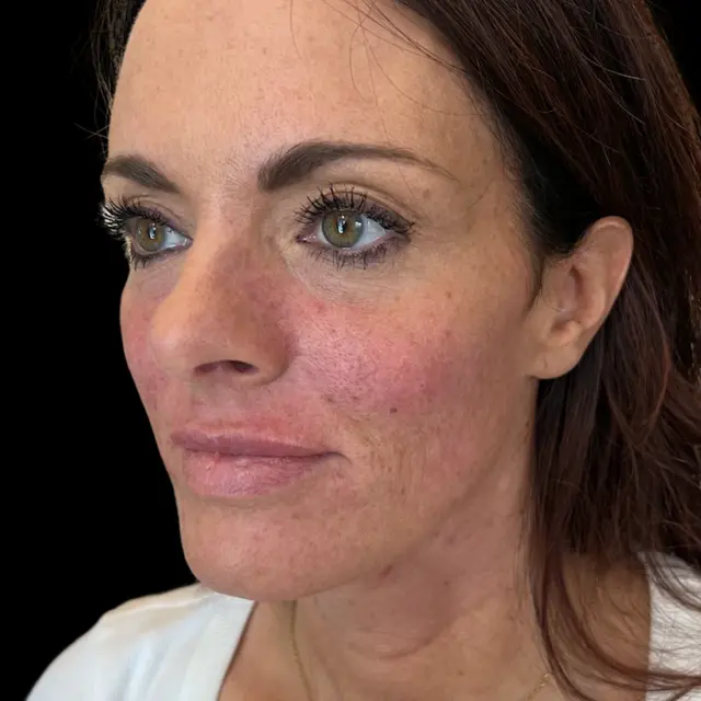 Dermal Fillers after at House of Aesthetics in Cary, NC