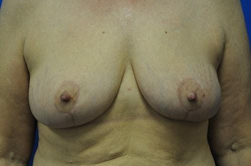 Lake Mary Plastic Surgery (James Shoukas, MD) breast lift after — Lake Mary, FL