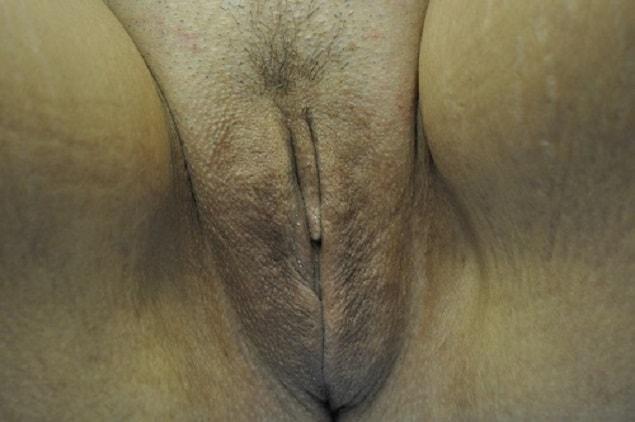 Lake Mary Plastic Surgery (James Shoukas, MD) labiaplasty after — Lake Mary, FL