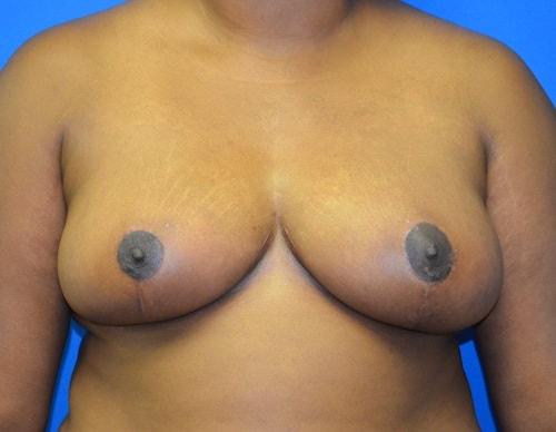 Lake Mary Plastic Surgery (James Shoukas, MD) breast lift after — Lake Mary, FL