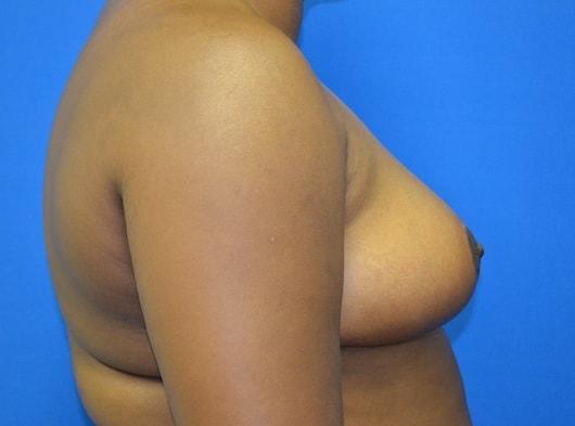 Lake Mary Plastic Surgery (James Shoukas, MD) breast lift after — Lake Mary, FL