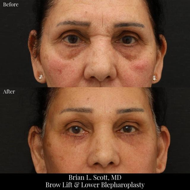 Brow Lift result at Brian L. Scott, MD in Bellevue, WA